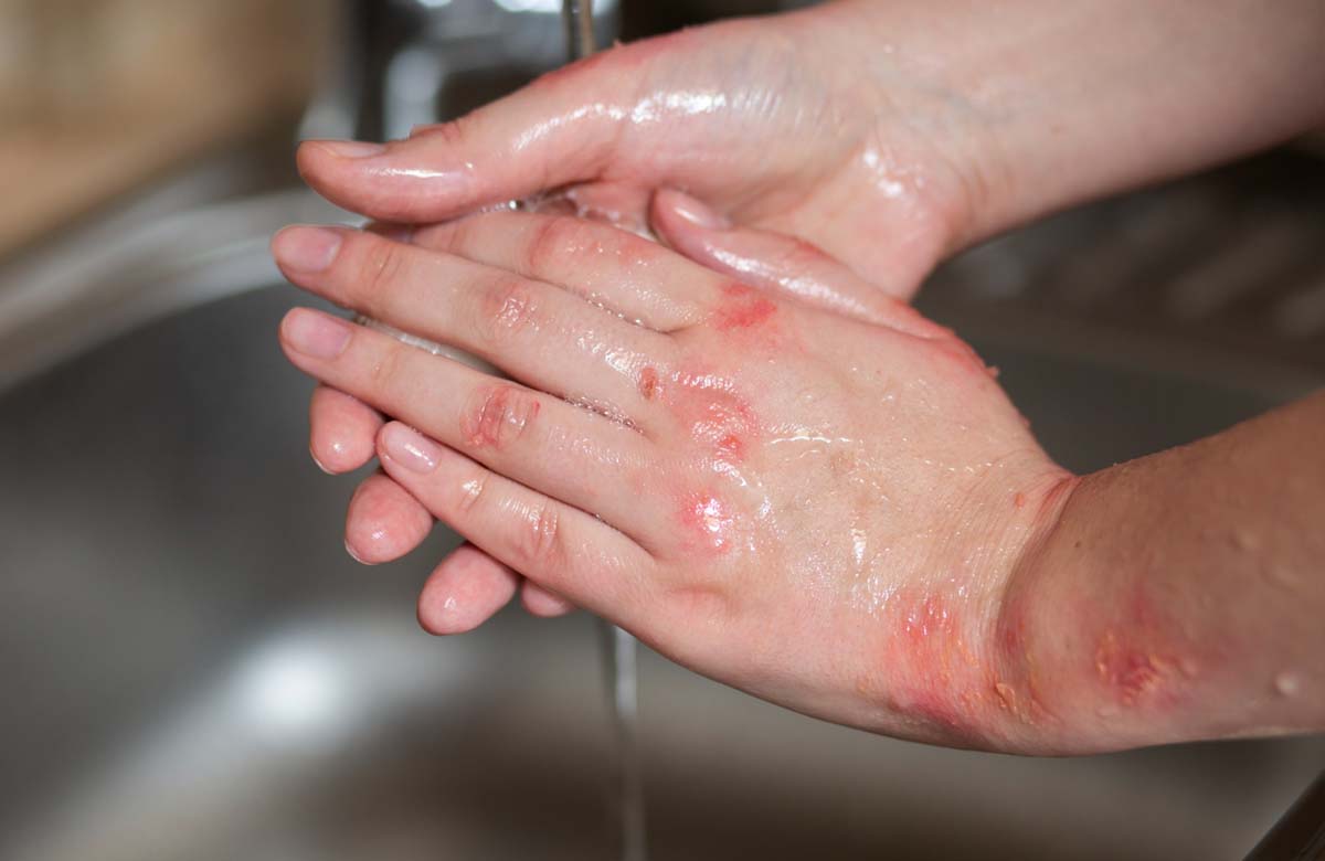 Bolhas, coceira e descamação podem apontar disidrose